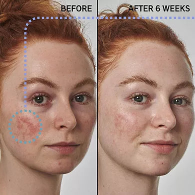 The INKEY List SuperSolutions 10% Azelaic Serum – Redness Relief Solution