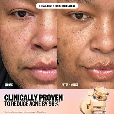 Peace Out 2% Salicylic Acid Acne Gel Moisturizer