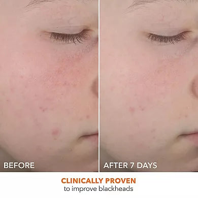 Dr. Dennis Gross Skincare Alpha Beta On The Spot Eliminator Gel para Acne con 2% de Ácido Salicílico