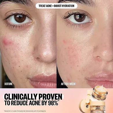 Peace Out 2% Salicylic Acid Acne Gel Moisturizer