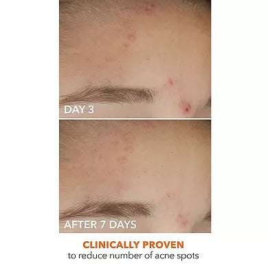 Dr. Dennis Gross Skincare Alpha Beta On The Spot Eliminator Gel para Acne con 2% de Ácido Salicílico